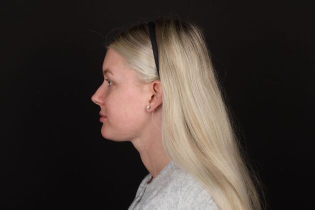 Face & Neck Lifts: Case 61 - After