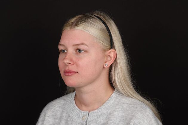 Face & Neck Lifts: Case 61 - After