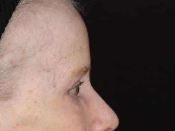 Forehead & Brow Lifts: Case 11 - After