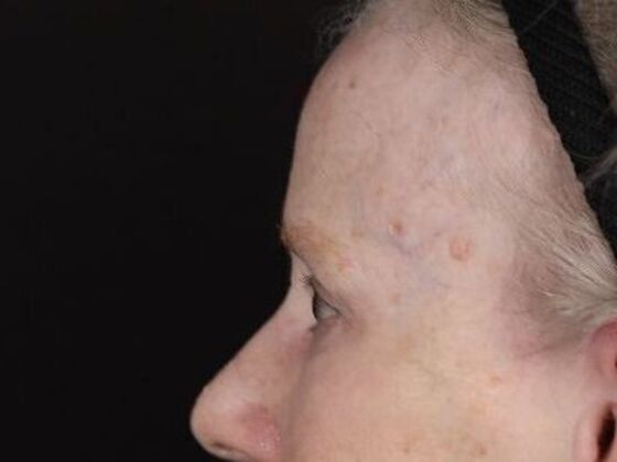 Forehead & Brow Lifts: Case 11 - After