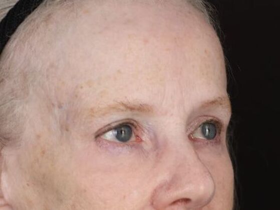 Forehead & Brow Lifts: Case 11 - After