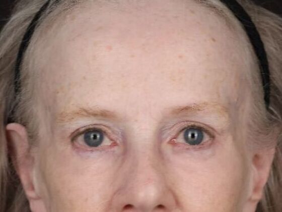 Forehead & Brow Lifts Case 11 - After