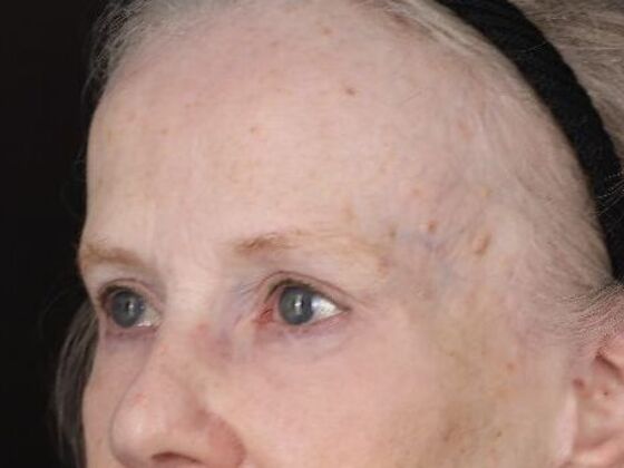 Forehead & Brow Lifts: Case 11 - After