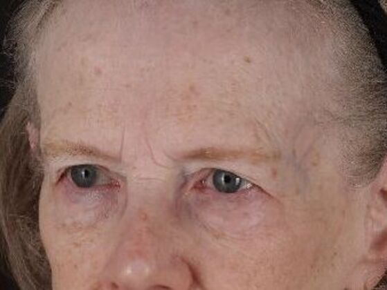Forehead & Brow Lifts: Case 11 - Before