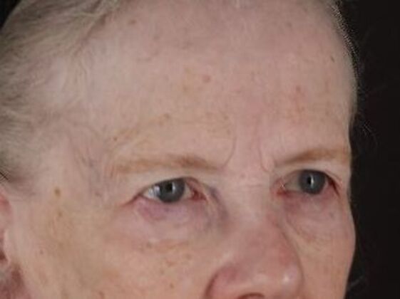 Forehead & Brow Lifts: Case 11 - Before