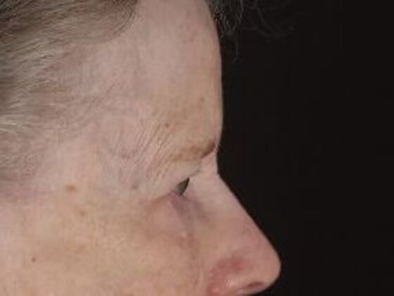 Forehead & Brow Lifts: Case 11 - Before