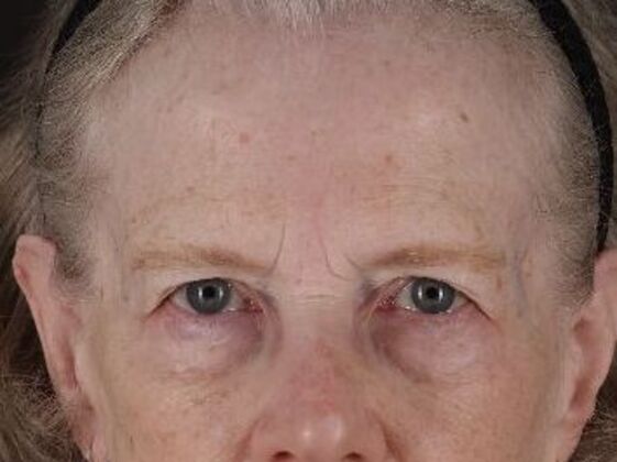 Forehead & Brow Lifts Case 11 - Before