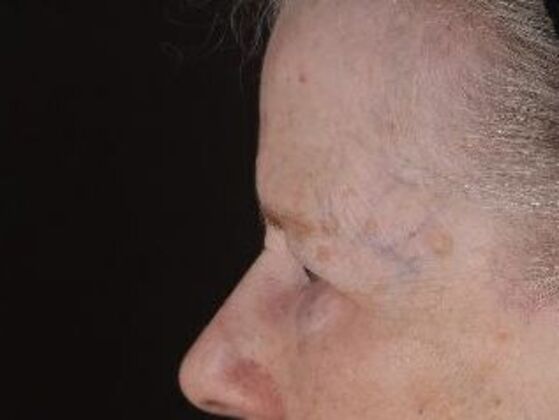 Forehead & Brow Lifts: Case 11 - Before