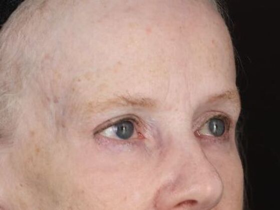 Eyelid Surgery: Case 28 - After