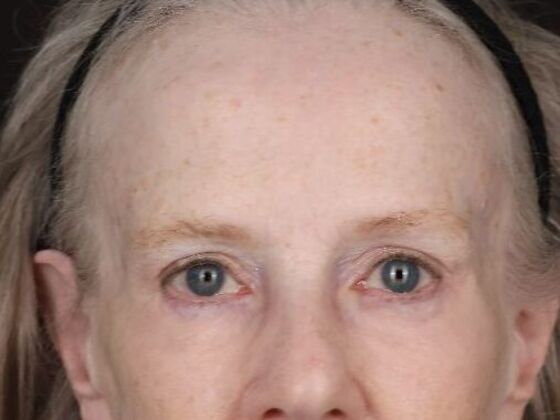 Eyelid Surgery: Case 28 - After