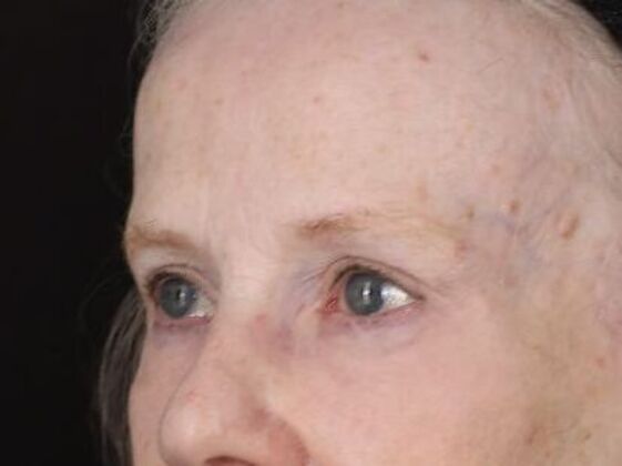 Eyelid Surgery: Case 28 - Before