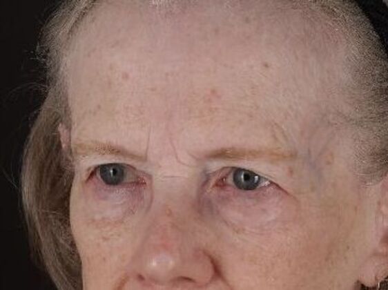 Eyelid Surgery: Case 28 - After