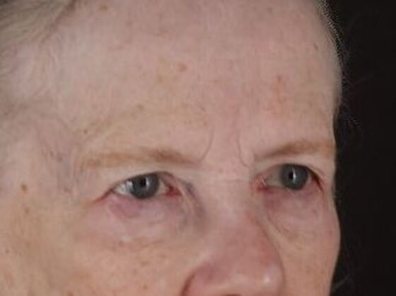 Eyelid Surgery: Case 28 - Before
