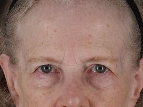 Eyelid Surgery: Case 28 - Before