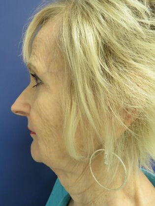 Facelift / Neck Lift Case 26 - Before