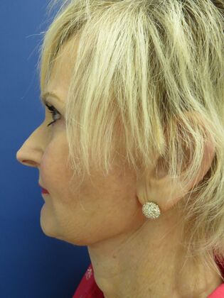 Facelift / Neck Lift Case 26 - After