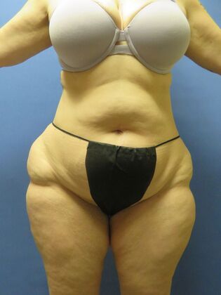 Liposuction Case 11 - Before