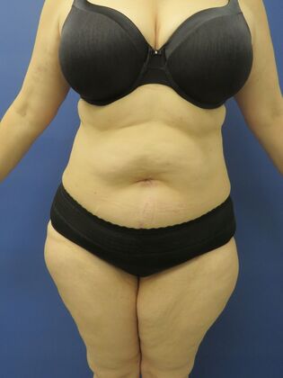 Liposuction Case 11 - After