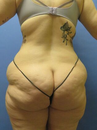 Liposuction: Case 11 - Before