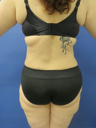 Liposuction: Case 11 - After