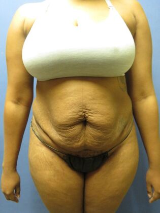 Abdominoplasty - Tummy Tuck: Case 34 - Before