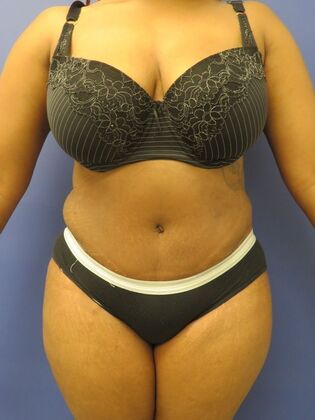 Abdominoplasty - Tummy Tuck: Case 34 - After