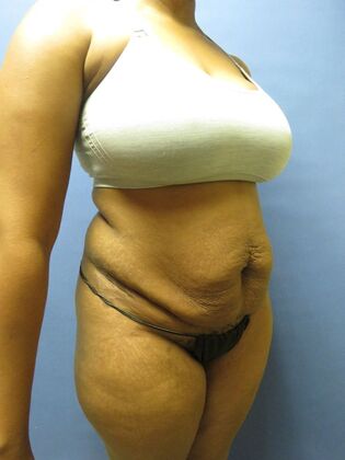 Abdominoplasty - Tummy Tuck: Case 34 - Before
