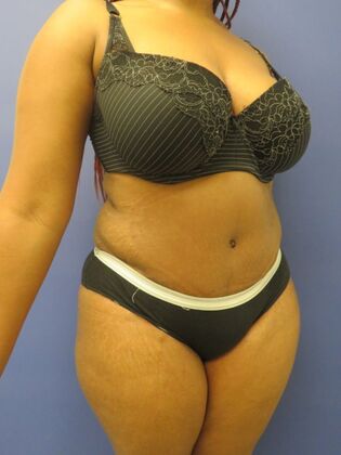 Abdominoplasty - Tummy Tuck: Case 34 - After