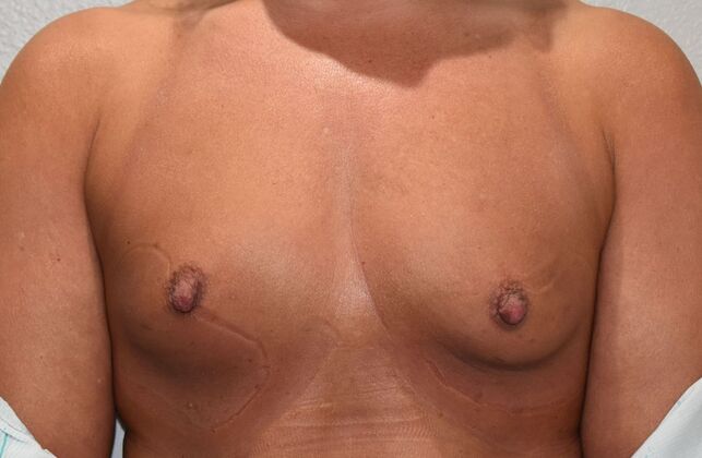 Breast Augmentation Case 826 - Before