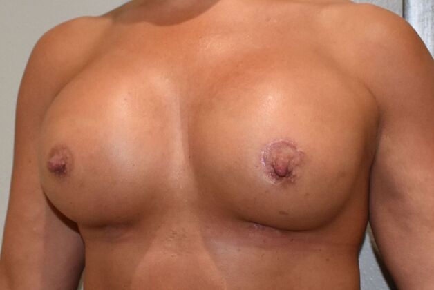Breast Augmentation w/ Lift: Case 653 - After