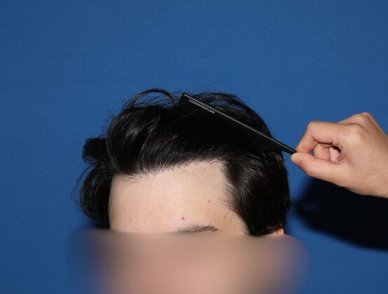 Hair Transplants Case 17 - FUE Repair Surgery - After