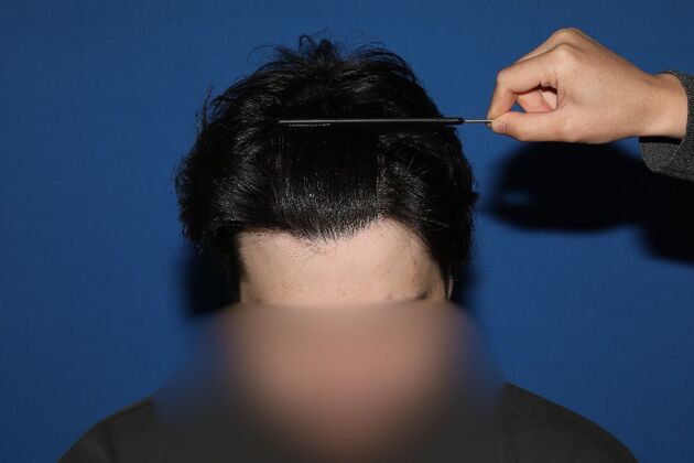 Hair Transplants: Case 17 - FUE Repair Surgery - After