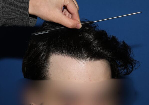 Hair Transplants: Case 17 - FUE Repair Surgery - After