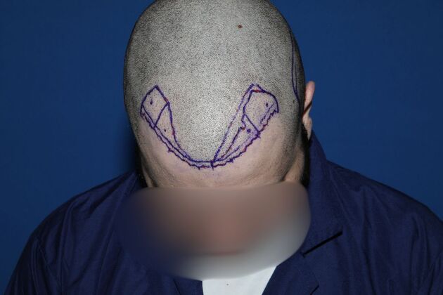 Hair Transplants: Case 17 - FUE Repair Surgery - Before