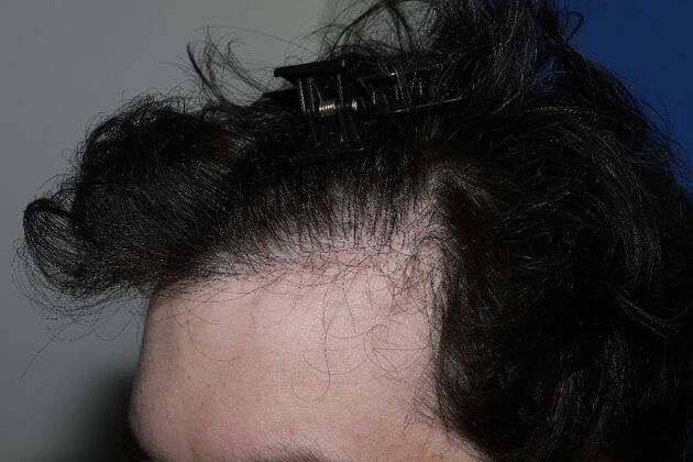 Hair Transplants Case 17 - FUE Repair Surgery - Before