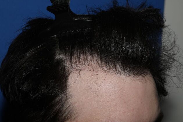 Hair Transplants: Case 17 - FUE Repair Surgery - After