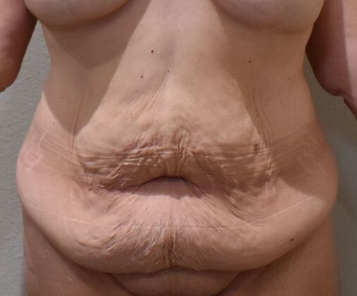 Tummy Tuck (Abdominoplasty) Case 593 - Before