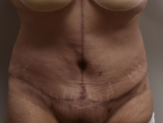 Tummy Tuck (Abdominoplasty) Case 593 - After