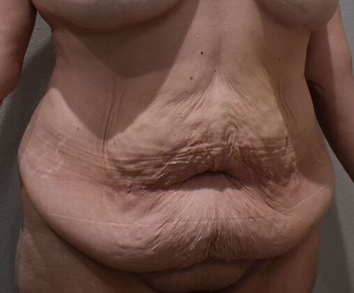 Massive Weight Loss : Case 217 - Before