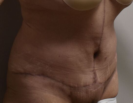 Massive Weight Loss : Case 217 - After