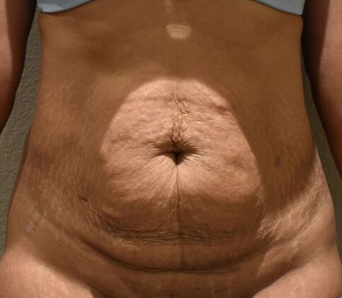 Tummy Tuck (Abdominoplasty) Case 594 - Before