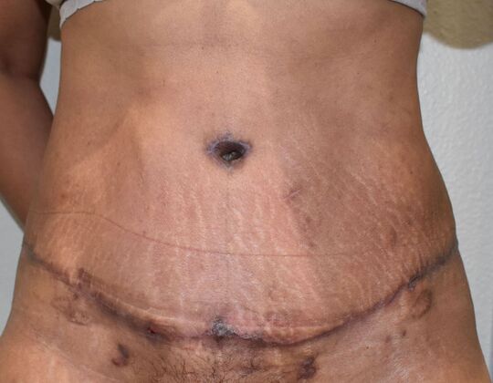 Tummy Tuck (Abdominoplasty) Case 594 - After