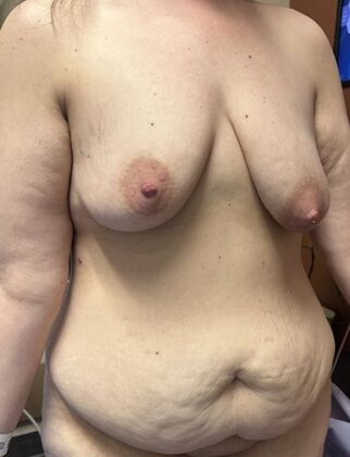 Massive Weight Loss : Case 218 - Before