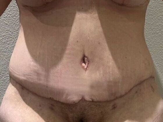 Tummy Tuck (Abdominoplasty) Case 595 - After