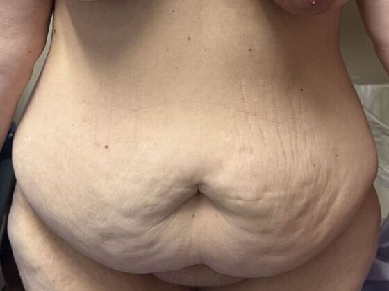 Tummy Tuck (Abdominoplasty) Case 595 - Before