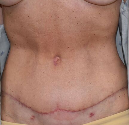Tummy Tuck (Abdominoplasty): Case 596 - After