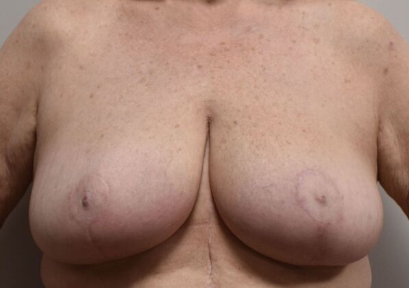 Breast Reduction: Case 224 - After