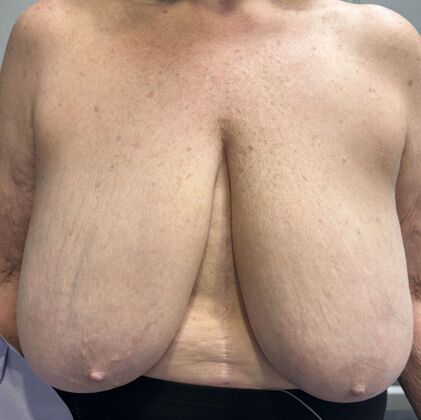 Breast Reduction: Case 224 - Before