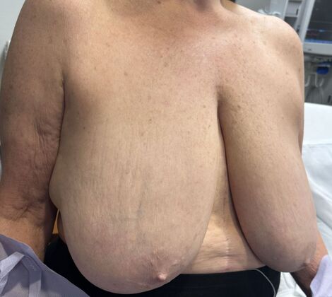 Breast Reduction: Case 224 - Before