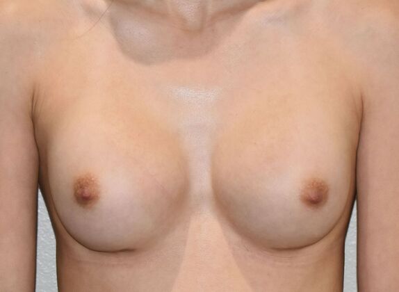 Breast Augmentation: Case 35 - After